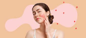 rosacea and makeup what you need to