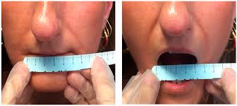 systemic scleroderma