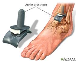 ankle replacement discharge