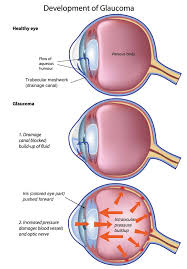 Glaucoma High Internal Eye Pressure That Causes Vision Loss