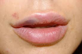 bruised lips from kissing top tips to