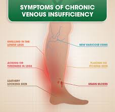 Some of these symptoms are â€¦ blood clots in the stomach, or an abdominal blood clot, are a type of deep vein thrombosis (dvt). Chronic Venous Insufficiency Cvi Doc Vein Management