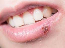 cold sore stop being conious