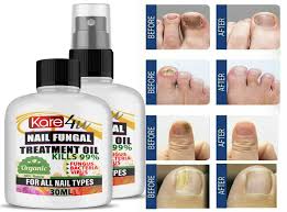 30ml fungal nail treatment highly