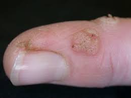 how to know if wart removal is