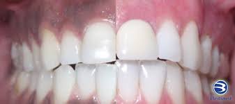 what causes a black spot on gums