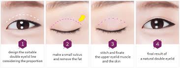 non incisional double eyelid surgery