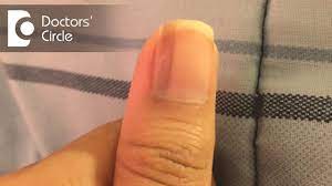 vertical black lines on fingernails