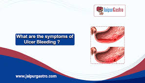 what are the symptoms of ulcer bleeding