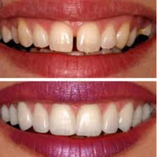 Cosmetic Dentistry Dr Shwethas Dental