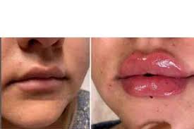 lip augmentation and lip lift in iran