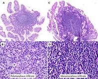 Image result for icd 10 code for lymphoid aggregates of colon