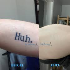 inkaway laser tattoo removal in chadds