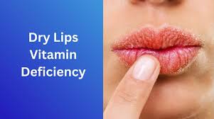 dry lips vitamin deficiency cal
