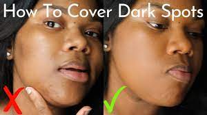 how to cover acne dark spots