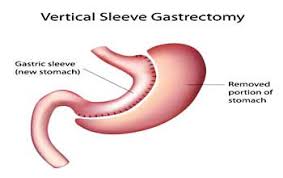 sleeve gastrectomy surgery india