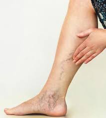 vein removal vascular interventional