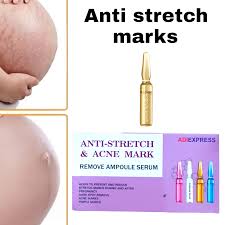 stretch marks cream after delivery