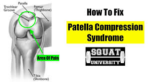 fix patellar compressive syndrome