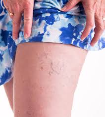 simple makeups to cover varicose veins