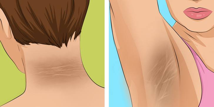 9 Symptoms of Diabetes That Most People Might Overlook