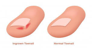 can an ingrown toenail be the source of