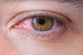 انتفاخ جفن العين .. أعراض تكشف اختراق كورونا العينين