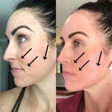 my experience w microneedling why i