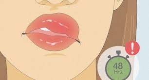 how to treat a fat lip 14 steps with