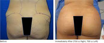 Who is the best bbl surgeon in houston? Brazilian Butt Lift Bbl In Dallas Fort Worth Tx Innovations Medical