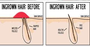 the correct way to remove ingrown hair