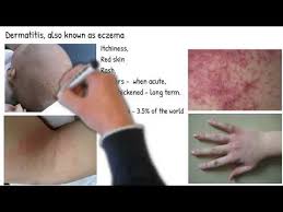 dermais vs eczema are they same