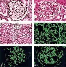 Thin Basement Membrane Nephropathy