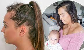 postpartum hair loss causes how to