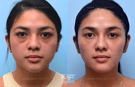 full face contouring before after