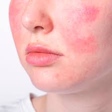 rosacea treatment 6 natural remes