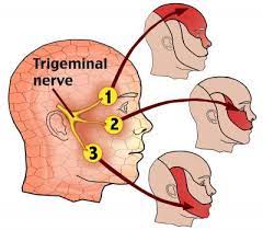 Trigeminal Nevraljinin Nedenleri Nelerdir?