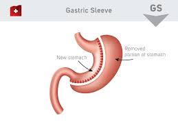 gastric sleeve surgery for weight loss