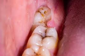 pericoronitis dental clinic in drhc dubai