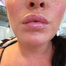 volbella injections in my lips