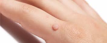 warts on the hands causes symptoms