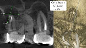 periapical x ray cone beam ct scan cbct