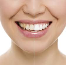 is teeth whitening permanent dr q