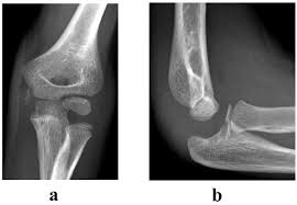 We have described a fracture dislocation of elbow in a 13 year old with associated medial epicondyle and lateral condyle fractures. Common Paediatric Elbow Injuries Fulltext
