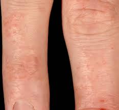 They are itchy and sore all the time. Itchy Rash Blog Of Online Skin Specialist