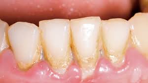 hole in gums causes symptoms