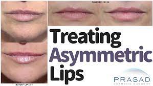 lip filler for uneven lips and smile