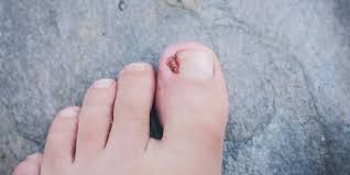 dealing with an infected ingrown toenail