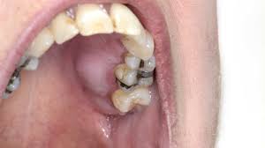 abscessed tooth symptoms causes