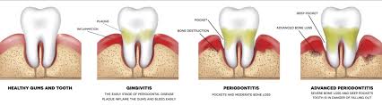 periodontal therapy plantation fl